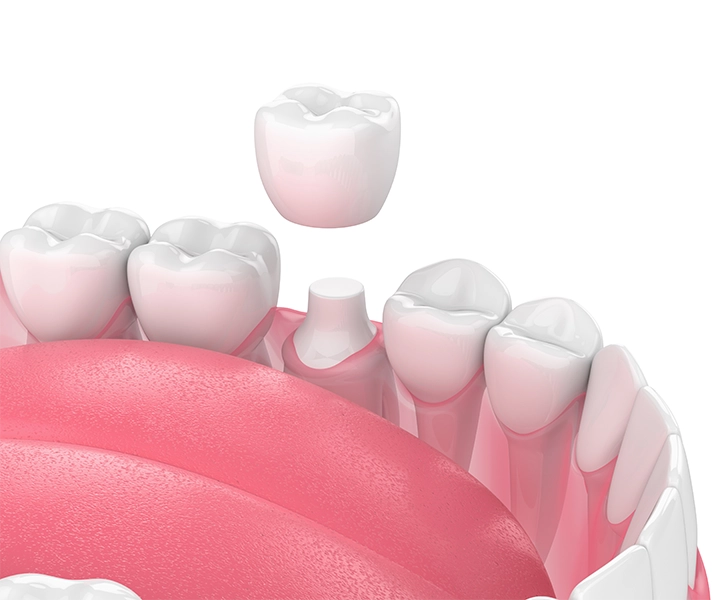 Upper Mt Gravatt Dentist - Blog - Dental crowns restore teeth and rejuvenate smiles - Dental Crown Illustration Dental crowns restore teeth and rejuvenate smiles