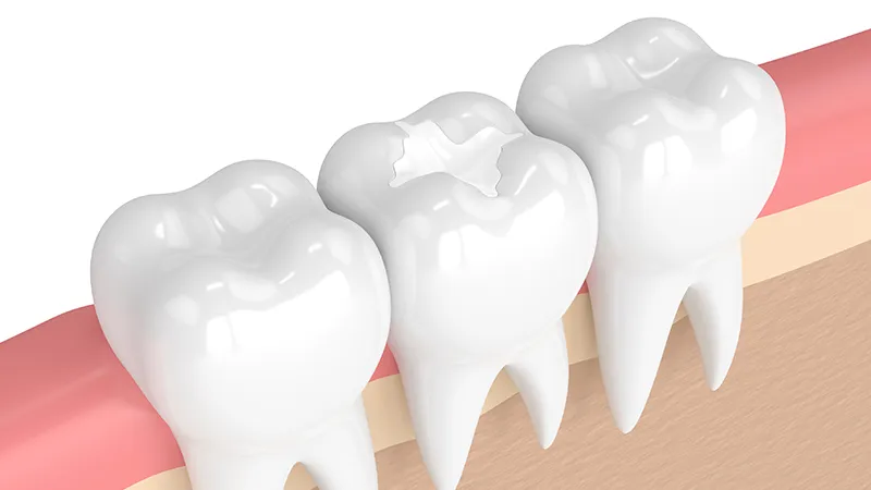 tooth-coloured fillings tooth-coloured fillings