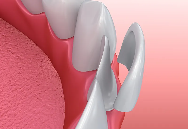 Veneers Veneers