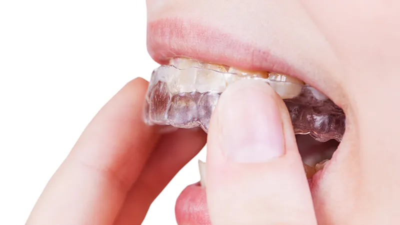 Clear aligners Clear aligners
