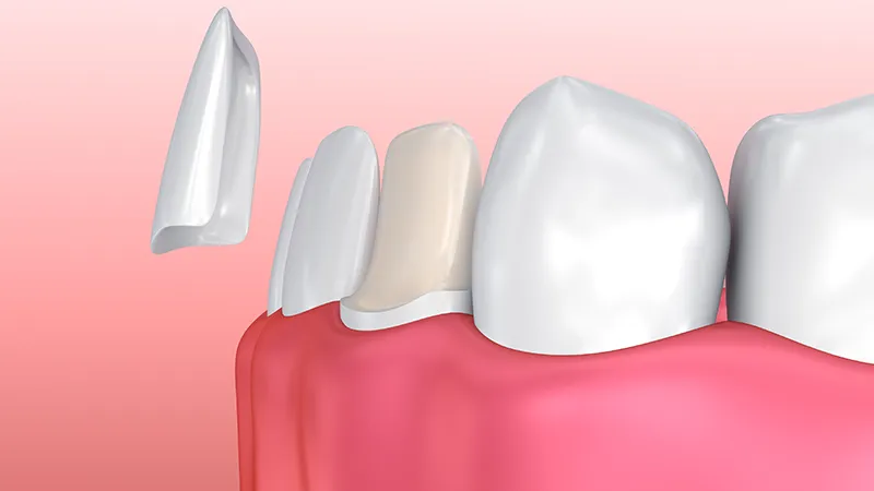 Dental veneers Dental veneers