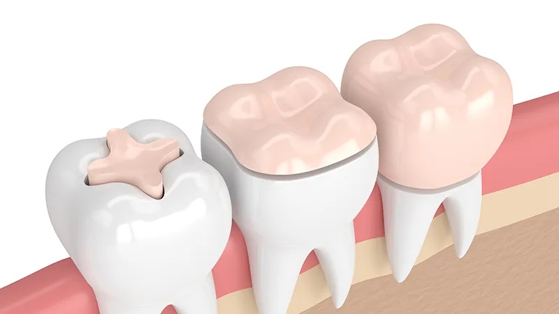 Dental inlays and onlays Dental inlays and onlays