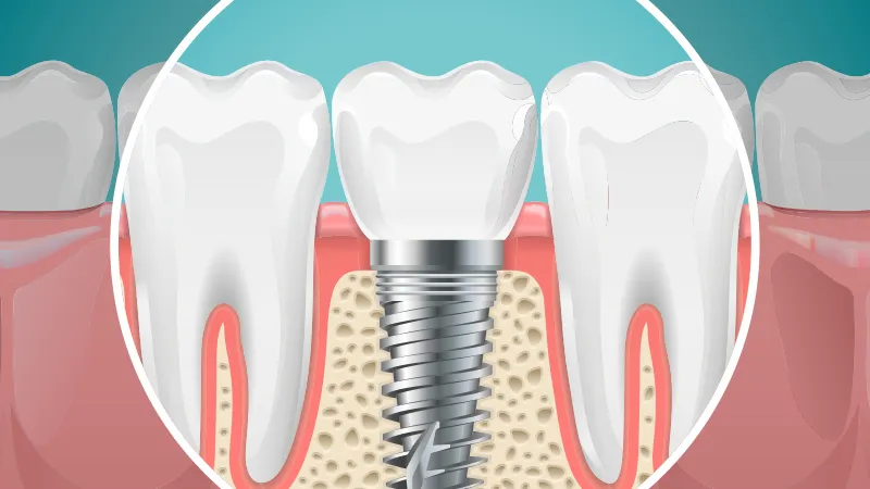 Dental implants Dental implants