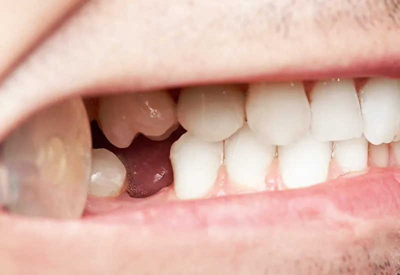 missing tooth missing tooth