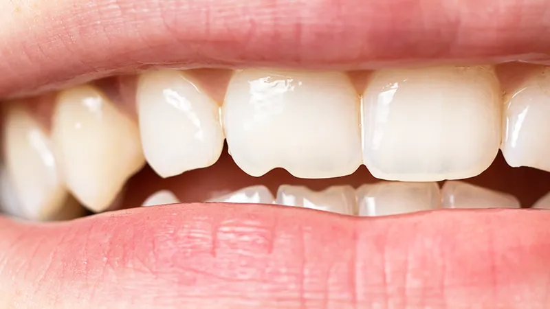 Broken teeth