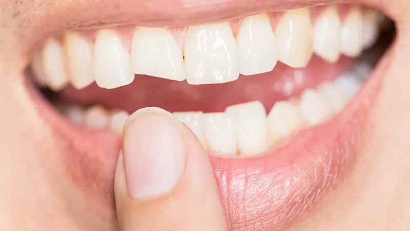 Knocked-out teeth Knocked-out teeth