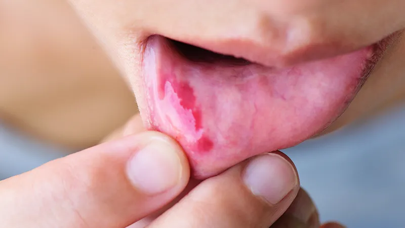 Soft tissue injuries Soft tissue injuries
