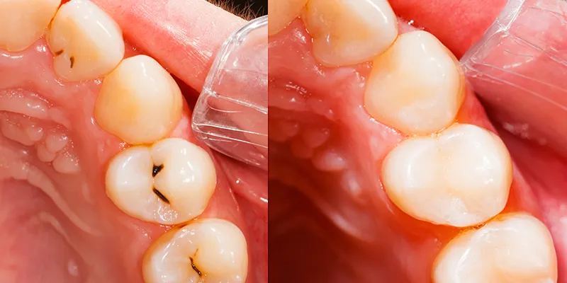 Dental fillings