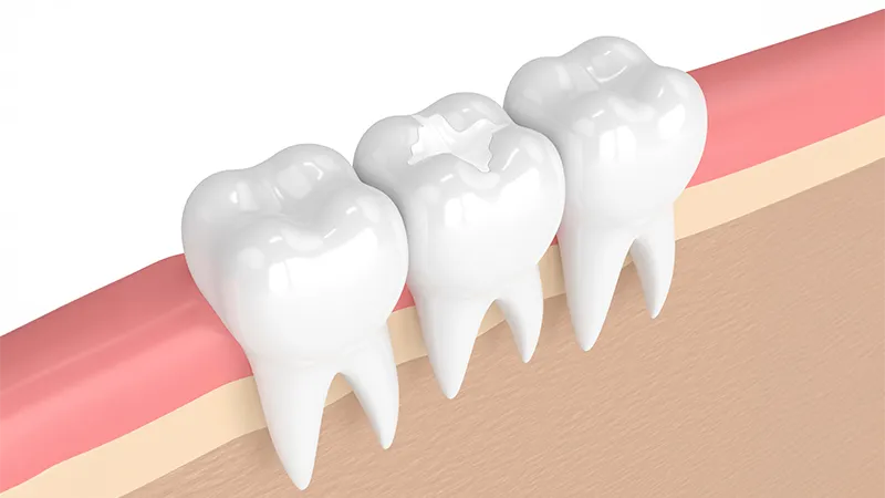 dental sealants dental sealants
