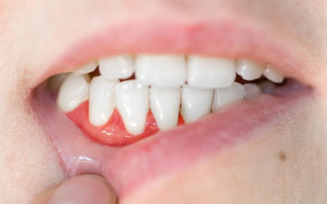 Gum disease: Causes, symptoms, prevention & treatment