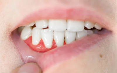 Gum disease: Causes, symptoms, prevention & treatment