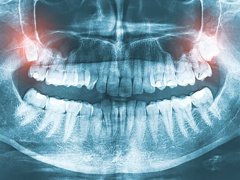 wisdom tooth wisdom tooth