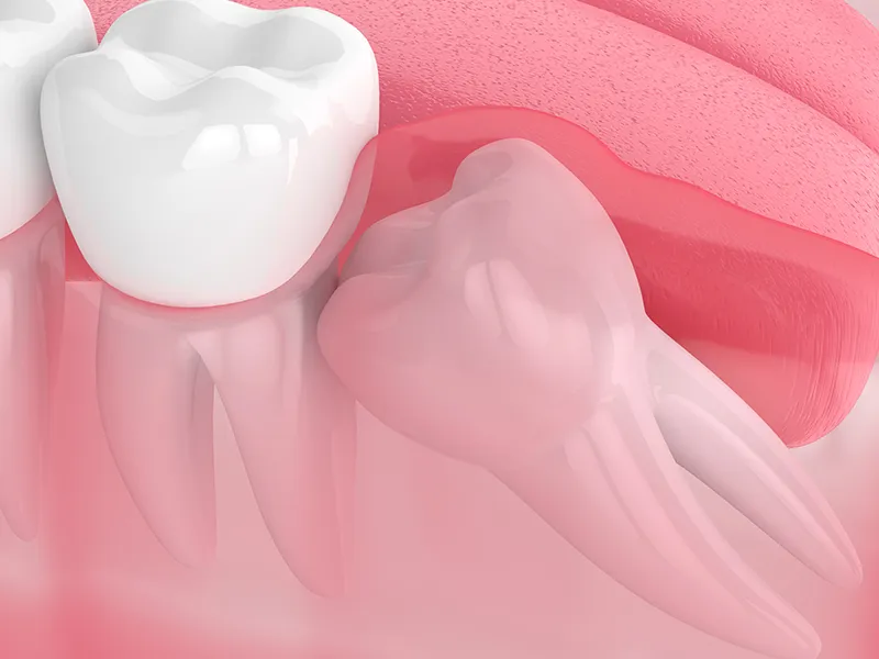 wisdom tooth wisdom tooth