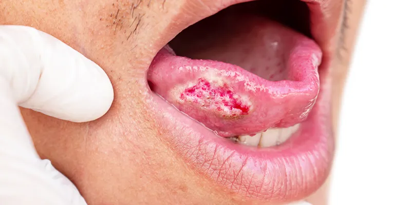 oral cancer oral cancer