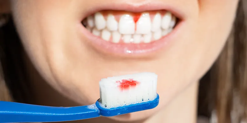 Gum disease Gum disease