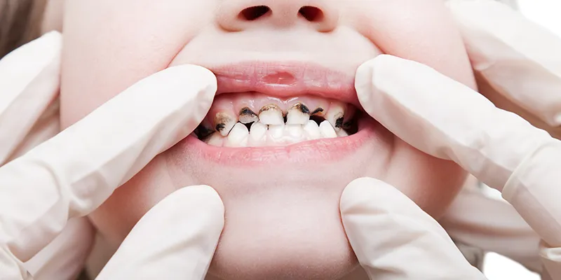 tooth decay tooth decay